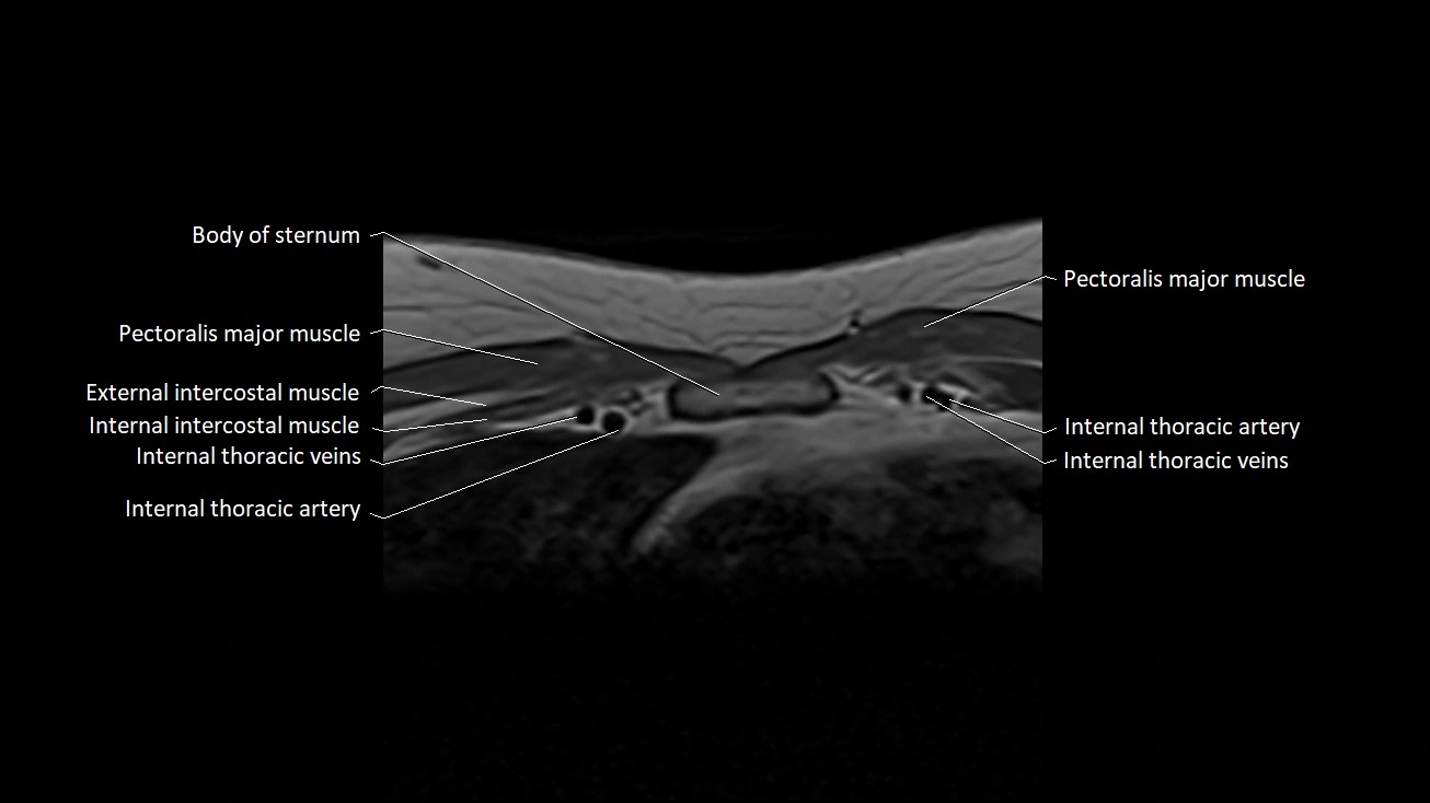 MRI sternum and sternoclavicular joint labeled axial anatomy image 16.webp
